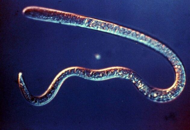 trichinella from the human body